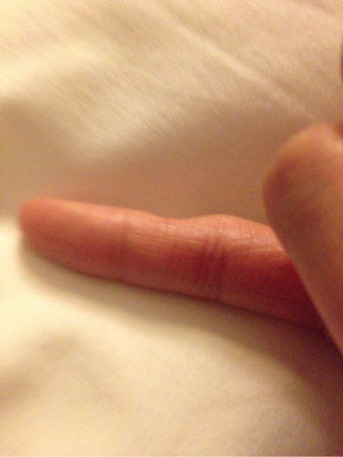 スマホの使い過ぎで小指が変形する人が増加中 あなたは大丈夫？